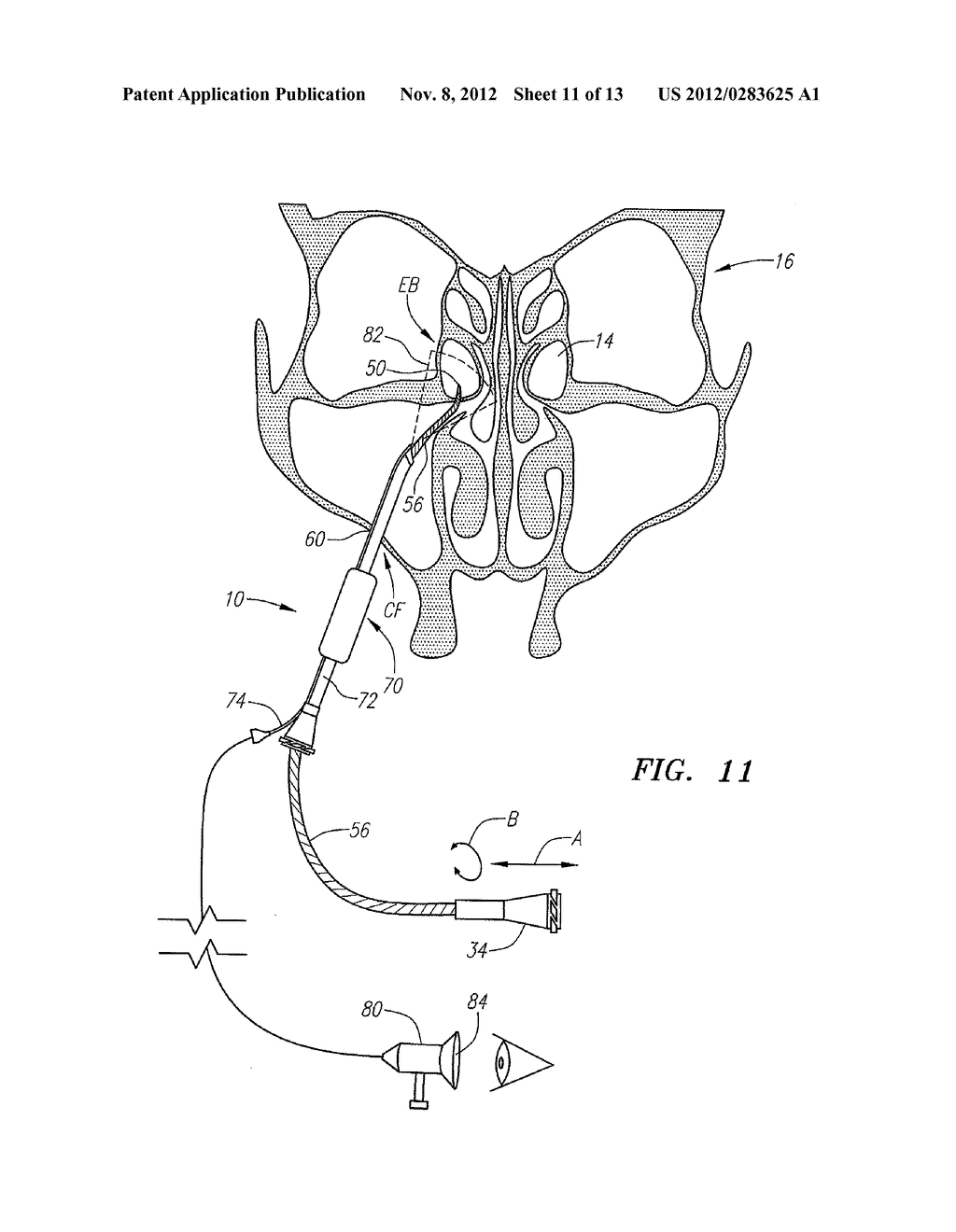 METHOD FOR TREATMENT OF ETHMOIDS - diagram, schematic, and image 12