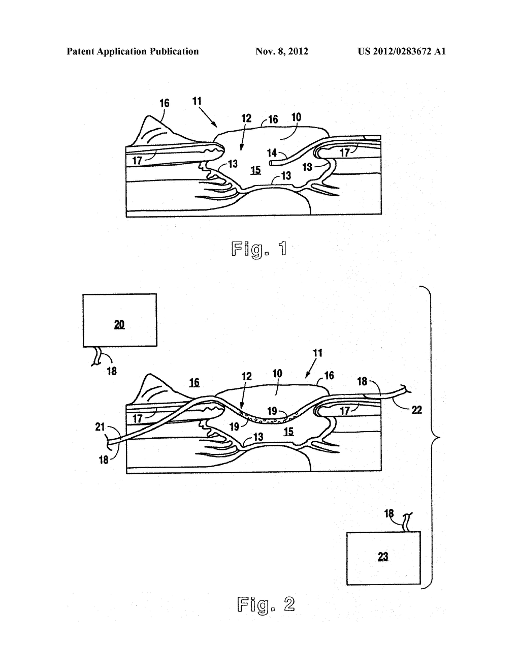 METHOD AND APPARATUS FOR WOUND TREATMENT - diagram, schematic, and image 02