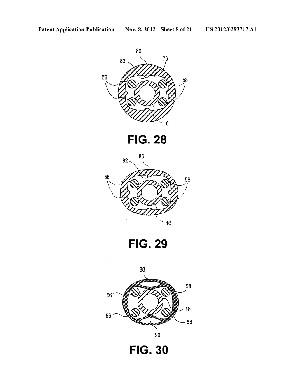 Uterine Therapy Device and Method - diagram, schematic, and image 09