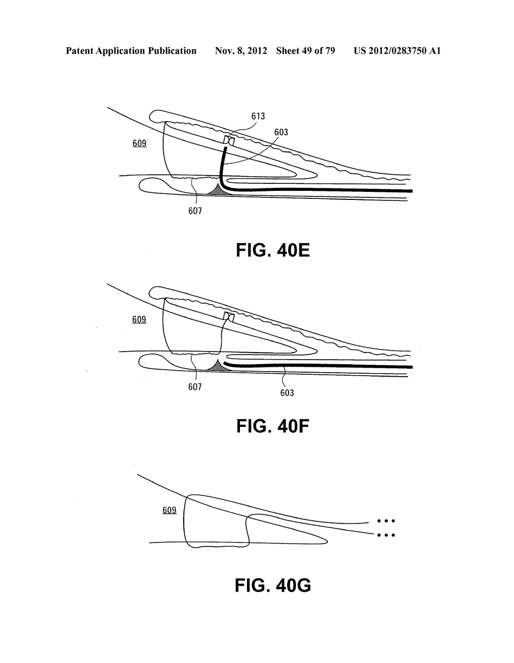 MENISCUS REPAIR - diagram, schematic, and image 50