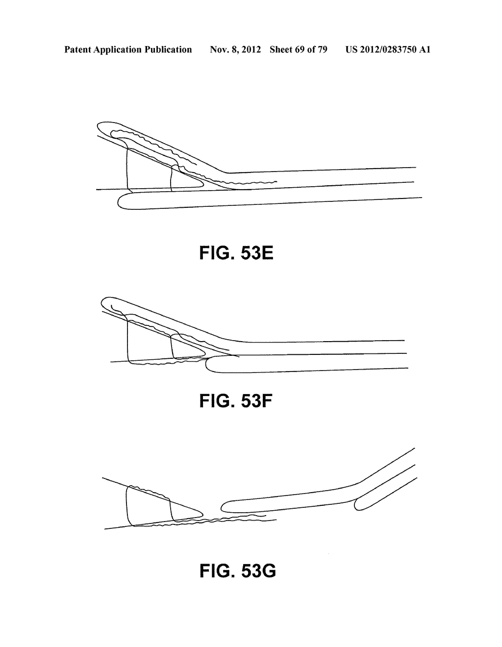 MENISCUS REPAIR - diagram, schematic, and image 70