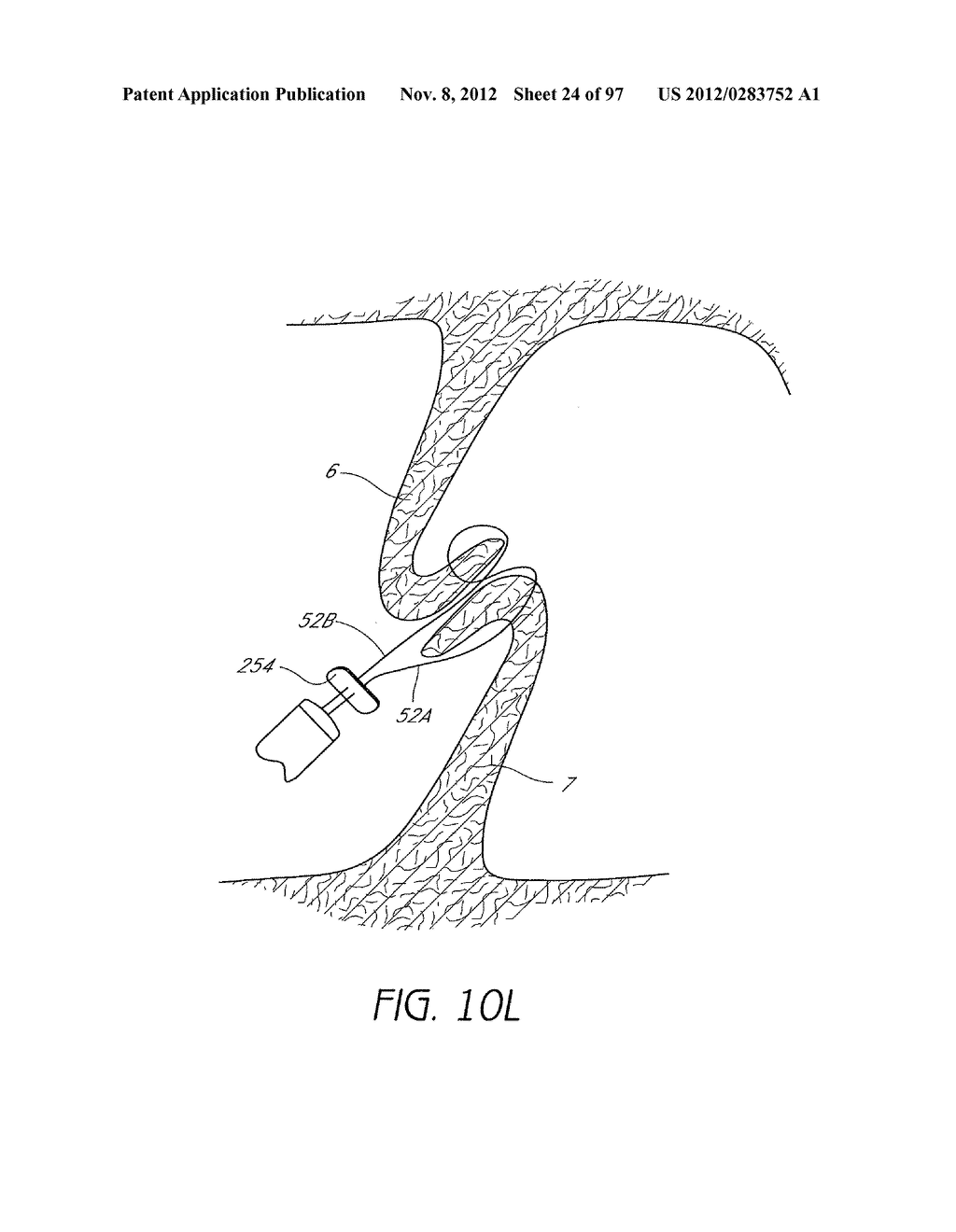 Suturing Devices and Methods for Closing a Patent Foramen Ovale - diagram, schematic, and image 25