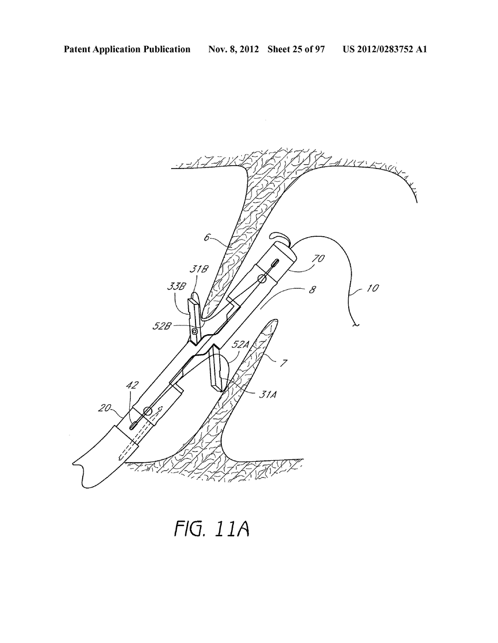 Suturing Devices and Methods for Closing a Patent Foramen Ovale - diagram, schematic, and image 26