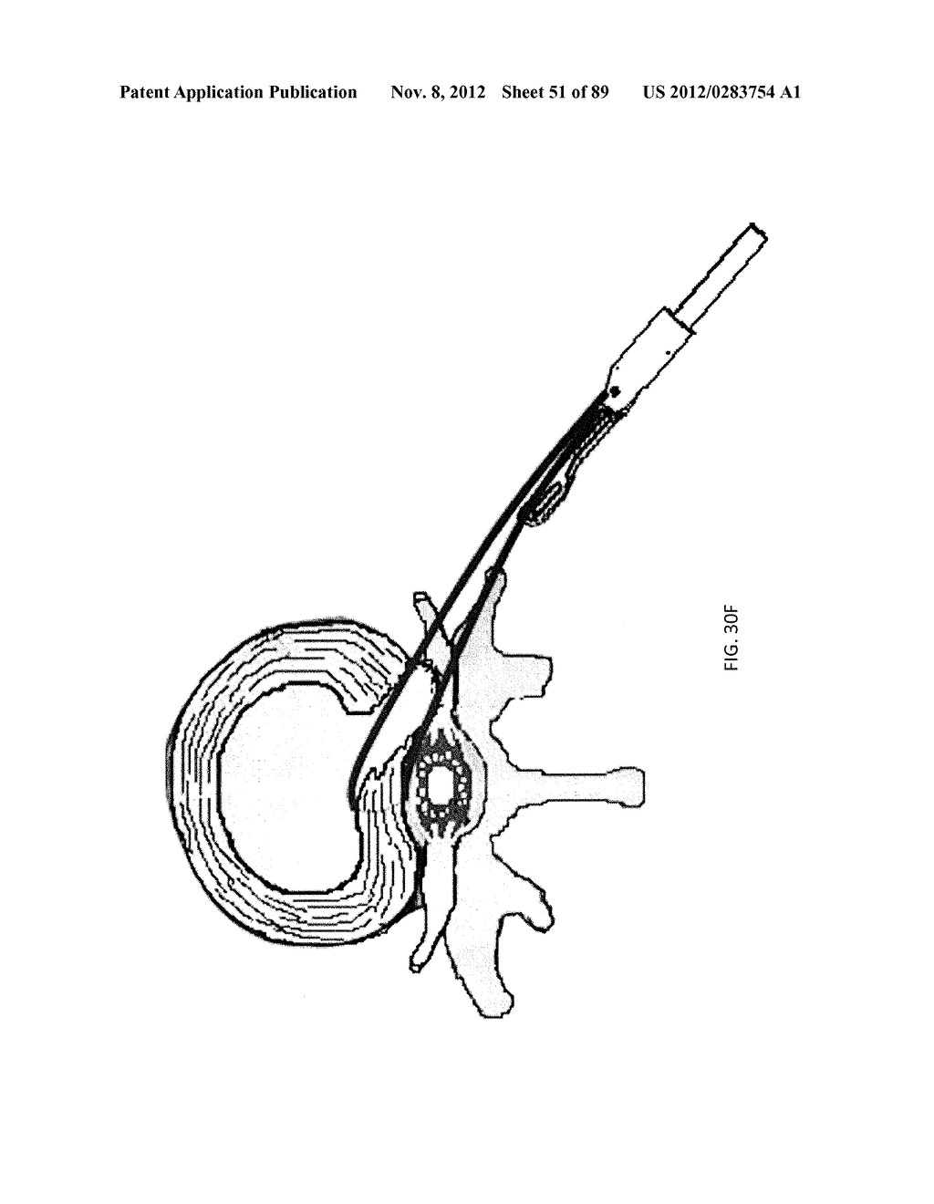 SUTURE PASSER DEVICES AND METHODS - diagram, schematic, and image 52