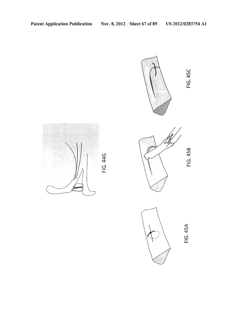 SUTURE PASSER DEVICES AND METHODS - diagram, schematic, and image 68