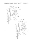 TISSUE ANCHOR FOR ANNULOPLASTY DEVICE diagram and image