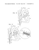 TISSUE ANCHOR FOR ANNULOPLASTY DEVICE diagram and image