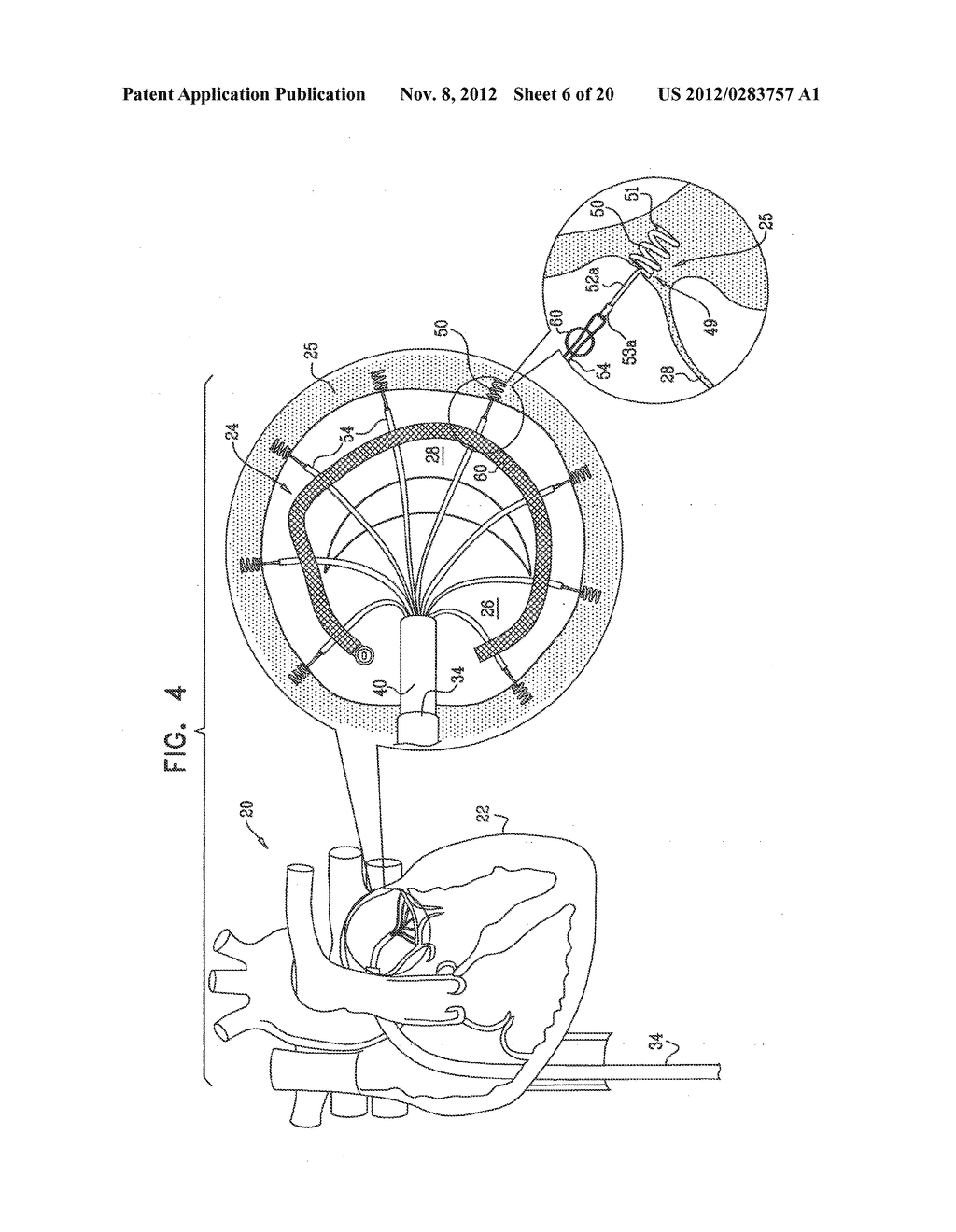 TISSUE ANCHOR FOR ANNULOPLASTY DEVICE - diagram, schematic, and image 07