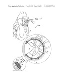 TISSUE ANCHOR FOR ANNULOPLASTY DEVICE diagram and image