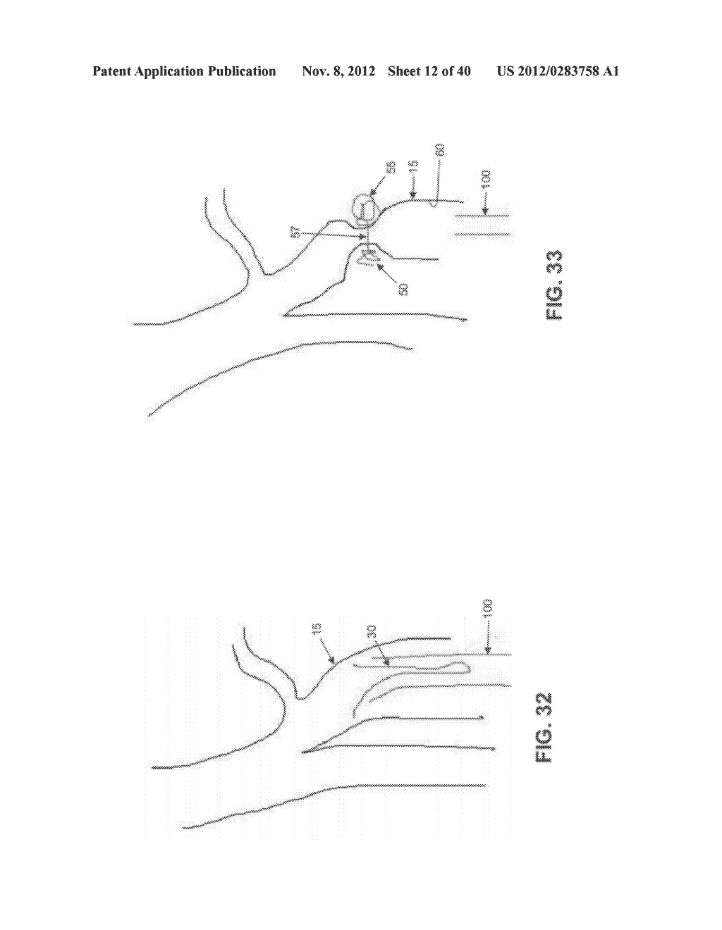 METHOD AND APPARATUS FOR TREATING VARICOSE VEINS - diagram, schematic, and image 13