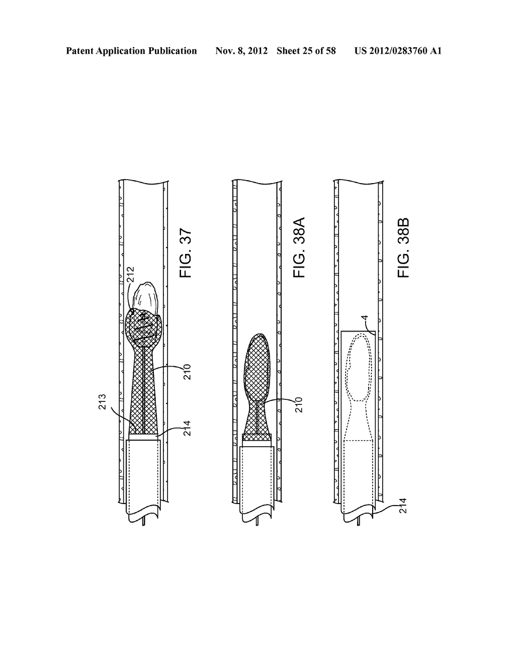 SYSTEMS, METHODS AND DEVICES FOR REMOVING OBSTRUCTIONS FROM A BLOOD VESSEL - diagram, schematic, and image 26