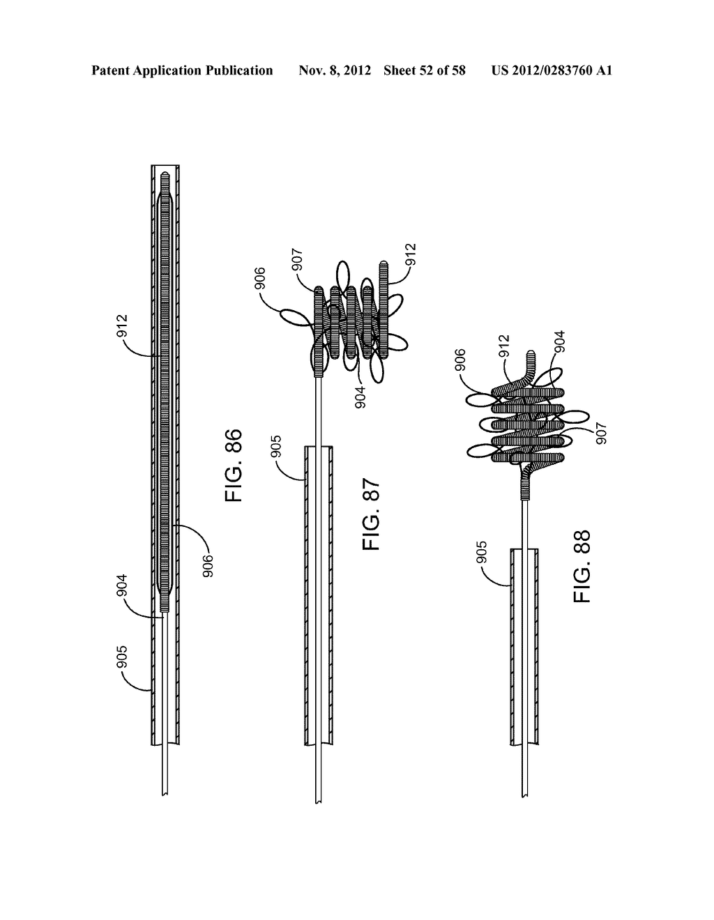 SYSTEMS, METHODS AND DEVICES FOR REMOVING OBSTRUCTIONS FROM A BLOOD VESSEL - diagram, schematic, and image 53