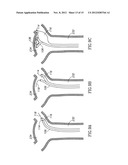 ANEURYSM COIL DELIVERY SYSTEM diagram and image