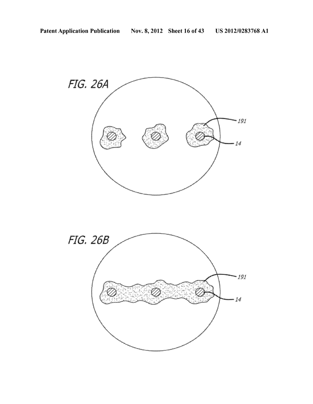 METHOD AND APPARATUS FOR THE TREATMENT OF LARGE AND GIANT VASCULAR DEFECTS - diagram, schematic, and image 17