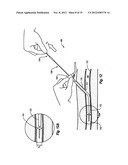 COMPRESSIBLE ARTERIOTOMY LOCATOR FOR VASCULAR CLOSURE DEVICES AND METHODS diagram and image