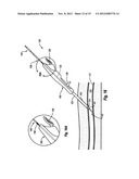 COMPRESSIBLE ARTERIOTOMY LOCATOR FOR VASCULAR CLOSURE DEVICES AND METHODS diagram and image