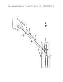 COMPRESSIBLE ARTERIOTOMY LOCATOR FOR VASCULAR CLOSURE DEVICES AND METHODS diagram and image