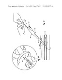 COMPRESSIBLE ARTERIOTOMY LOCATOR FOR VASCULAR CLOSURE DEVICES AND METHODS diagram and image