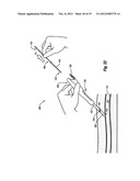 COMPRESSIBLE ARTERIOTOMY LOCATOR FOR VASCULAR CLOSURE DEVICES AND METHODS diagram and image