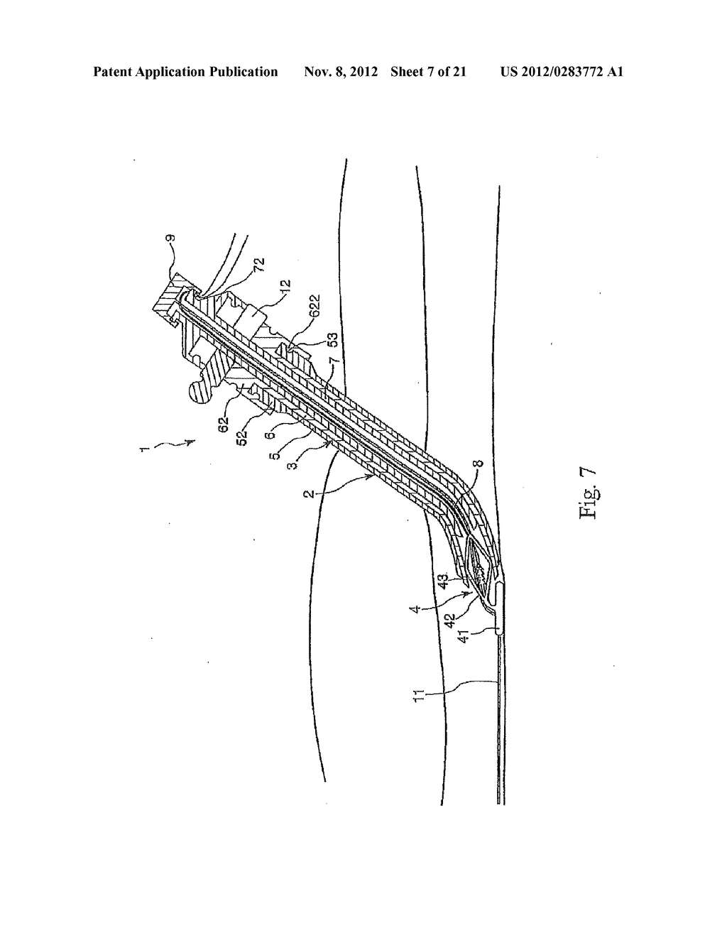 TISSUE CLOSURE AND TISSUE CLOSING DEVICE - diagram, schematic, and image 08