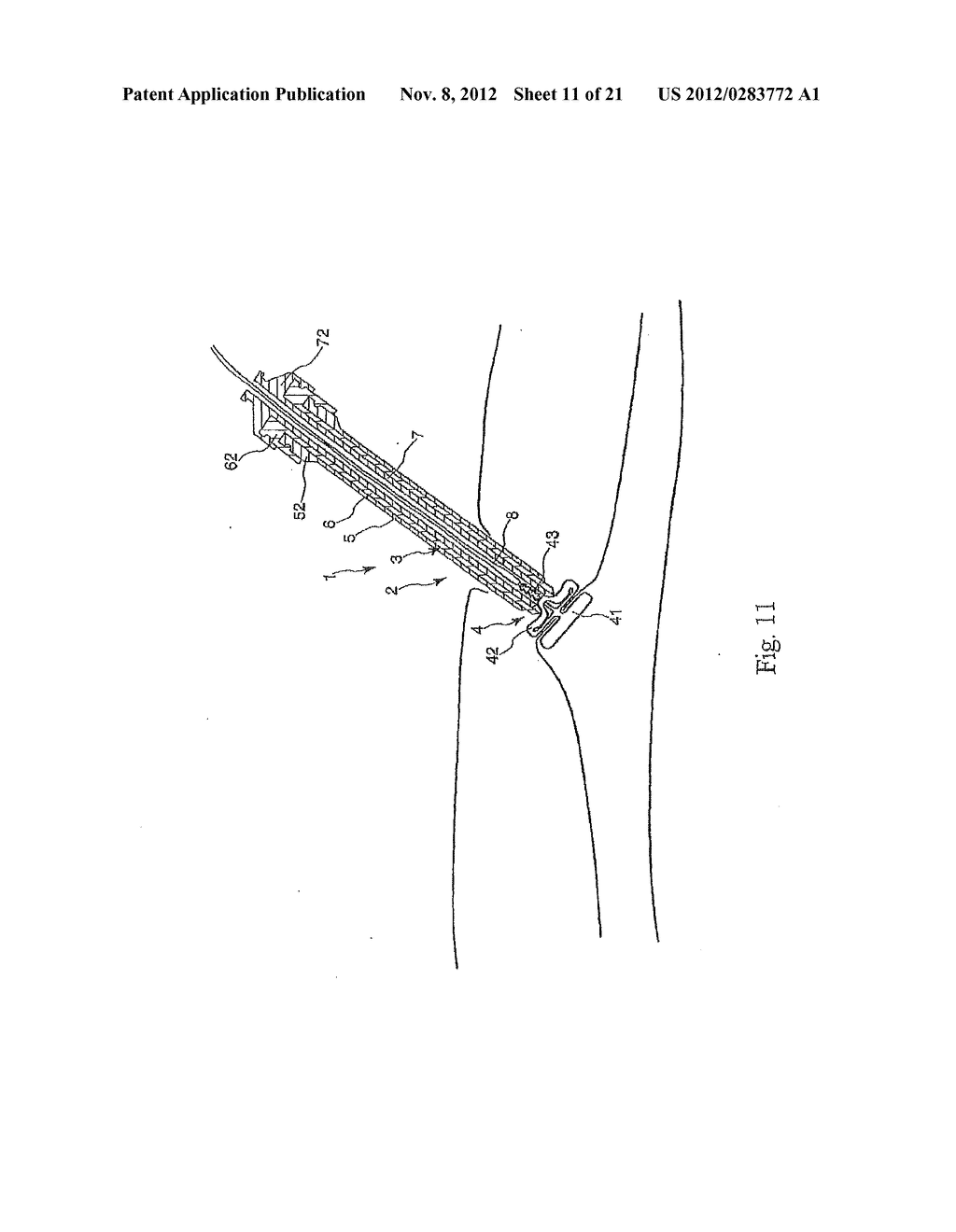 TISSUE CLOSURE AND TISSUE CLOSING DEVICE - diagram, schematic, and image 12