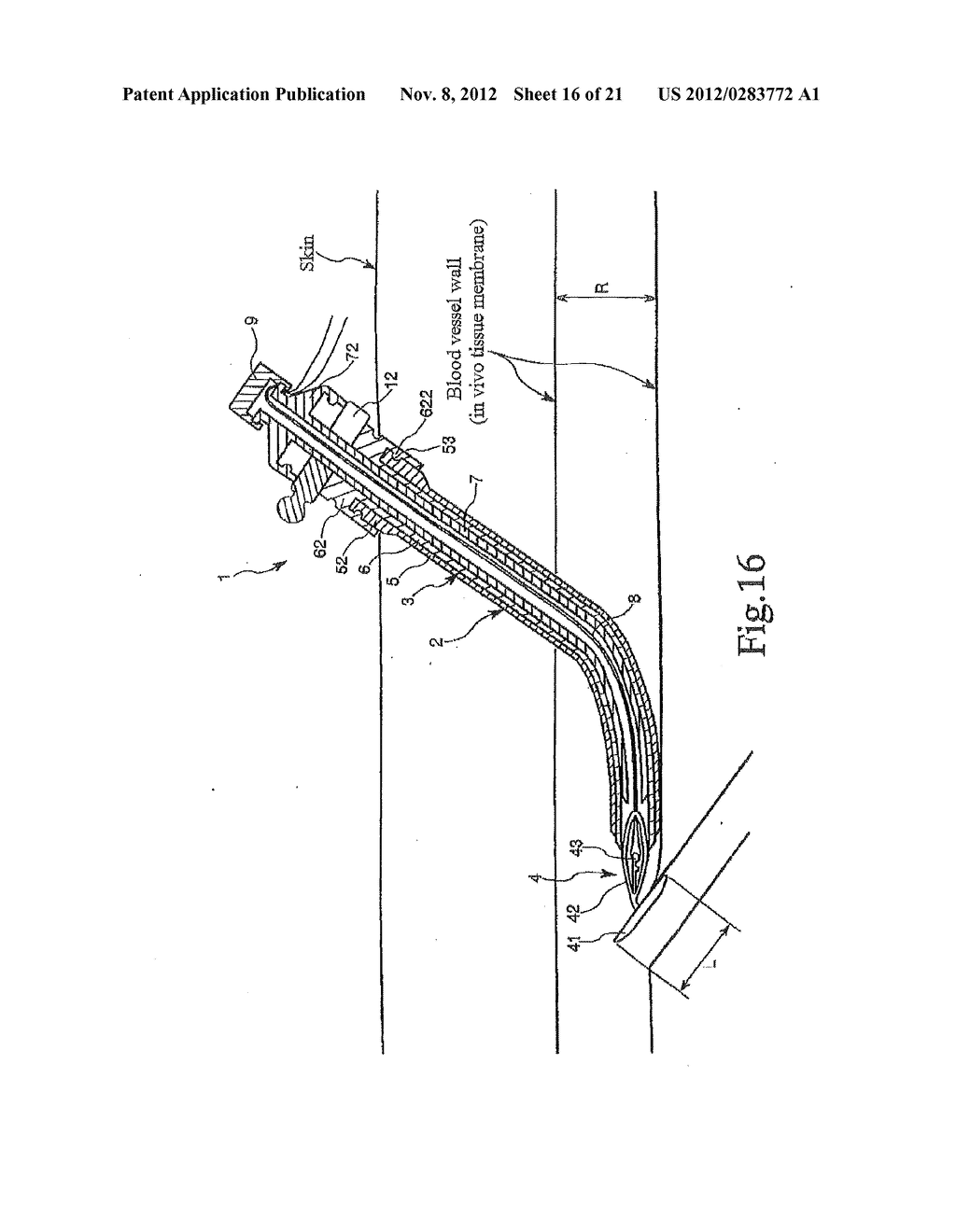 TISSUE CLOSURE AND TISSUE CLOSING DEVICE - diagram, schematic, and image 17