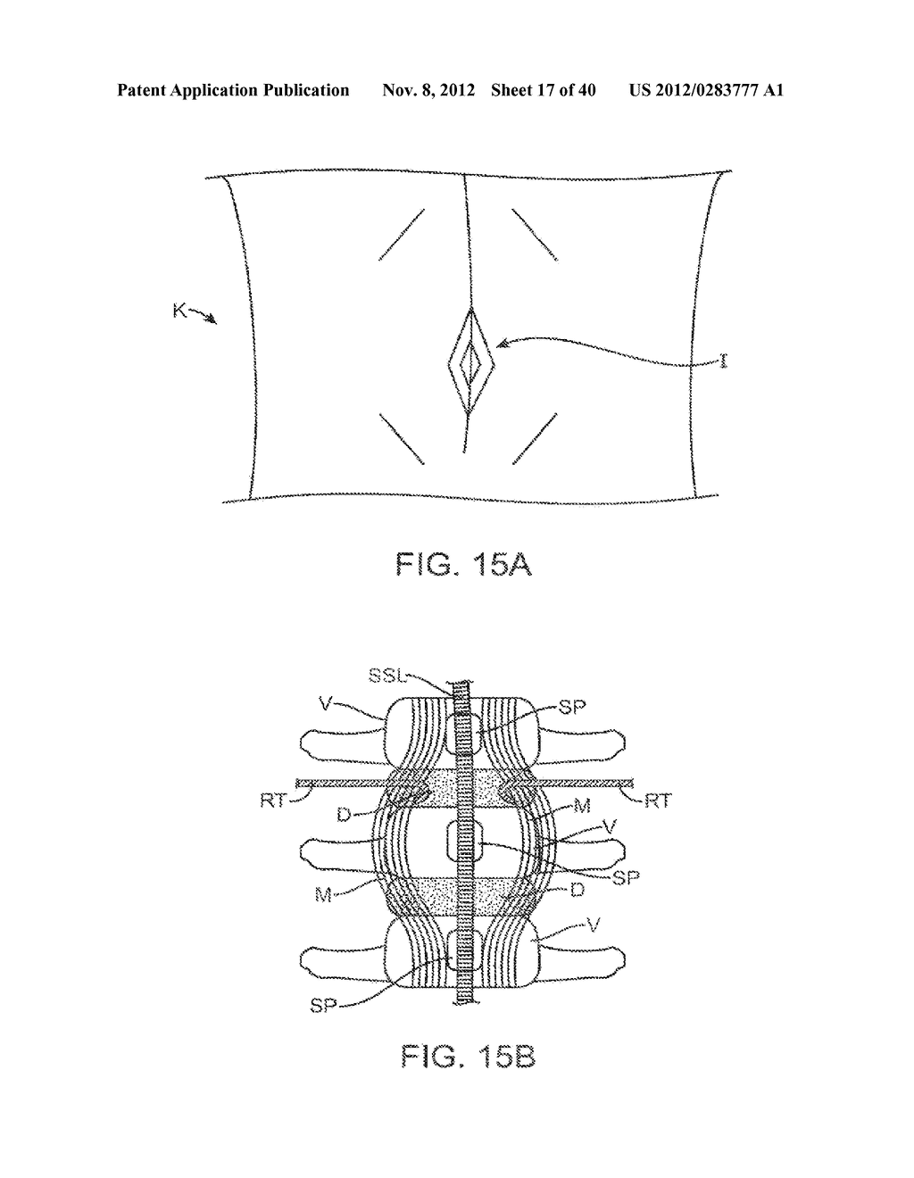 METHODS AND APPARATUS FOR DEPLOYING SPINOUS PROCESS CONSTRAINTS - diagram, schematic, and image 18