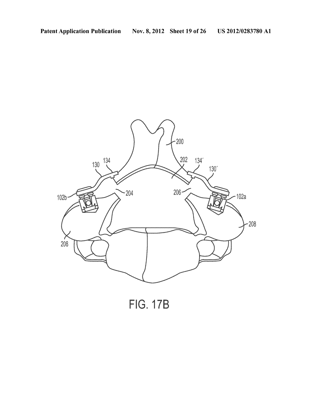 ROD ATTACHMENT FOR HEAD TO HEAD CROSS CONNECTOR - diagram, schematic, and image 20