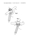 BONE ANCHORING DEVICE diagram and image