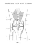 QUADRICEPS TENDON STRIPPER diagram and image