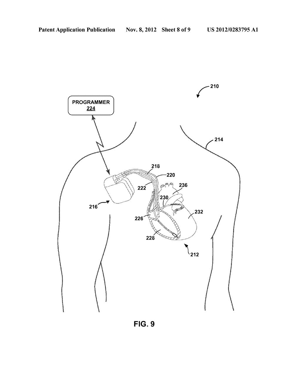 SELECTIVELY ENABLING A PASSIVE RECHARGE CYCLE FOR AN IMPLANTABLE CARDIAC     STIMULATION DEVICE - diagram, schematic, and image 09