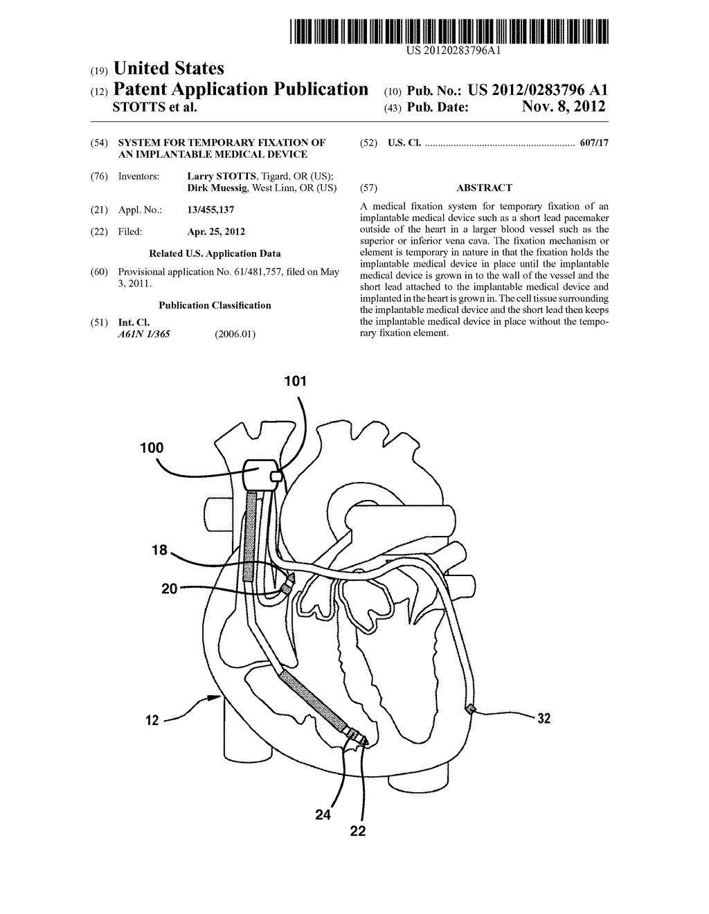 SYSTEM FOR TEMPORARY FIXATION OF AN IMPLANTABLE MEDICAL DEVICE - diagram, schematic, and image 01