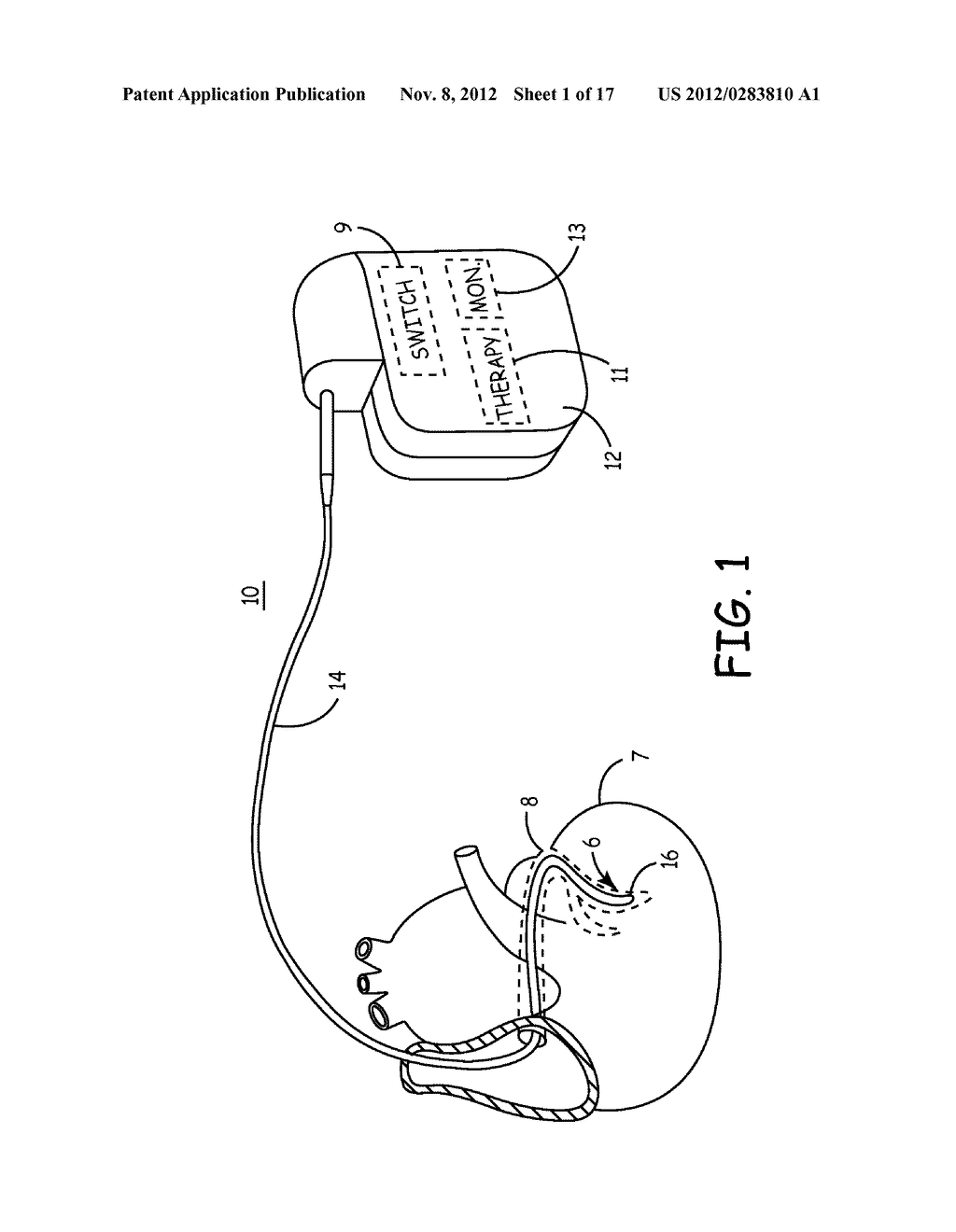 ACTIVE FIXATION MEDICAL LEAD - diagram, schematic, and image 02