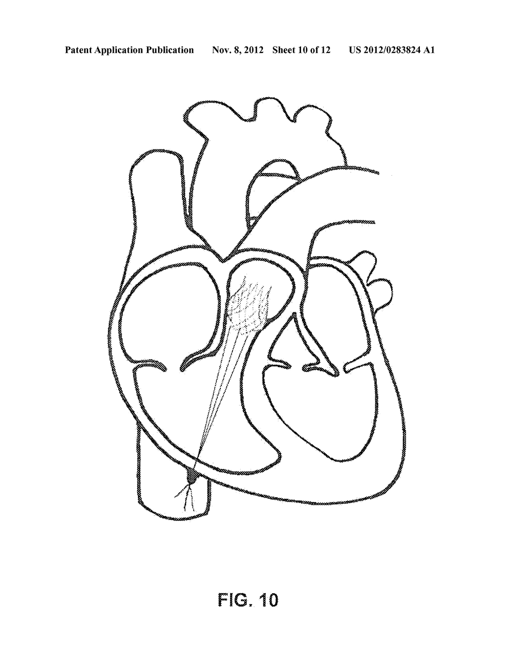 Heart Valve Stent - diagram, schematic, and image 11
