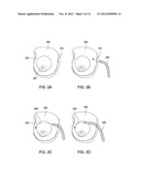 SYSTEMS AND METHODS FOR MASTOPEXY diagram and image