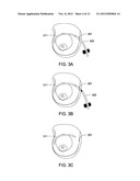 SYSTEMS AND METHODS FOR MASTOPEXY diagram and image