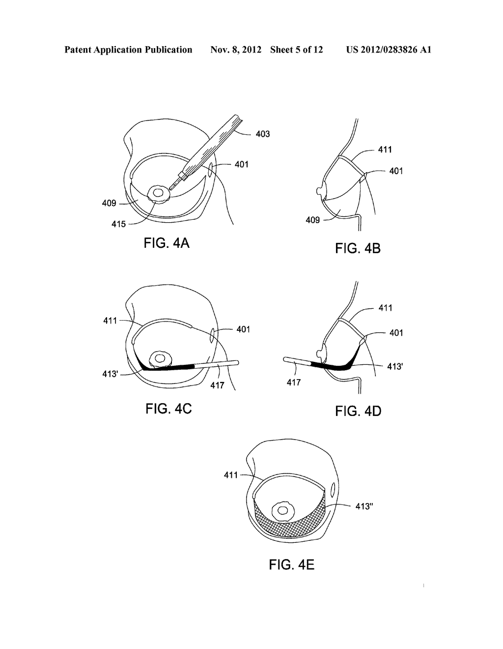 SYSTEMS AND METHODS FOR MASTOPEXY - diagram, schematic, and image 06