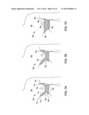 SYSTEMS AND METHODS FOR MASTOPEXY diagram and image