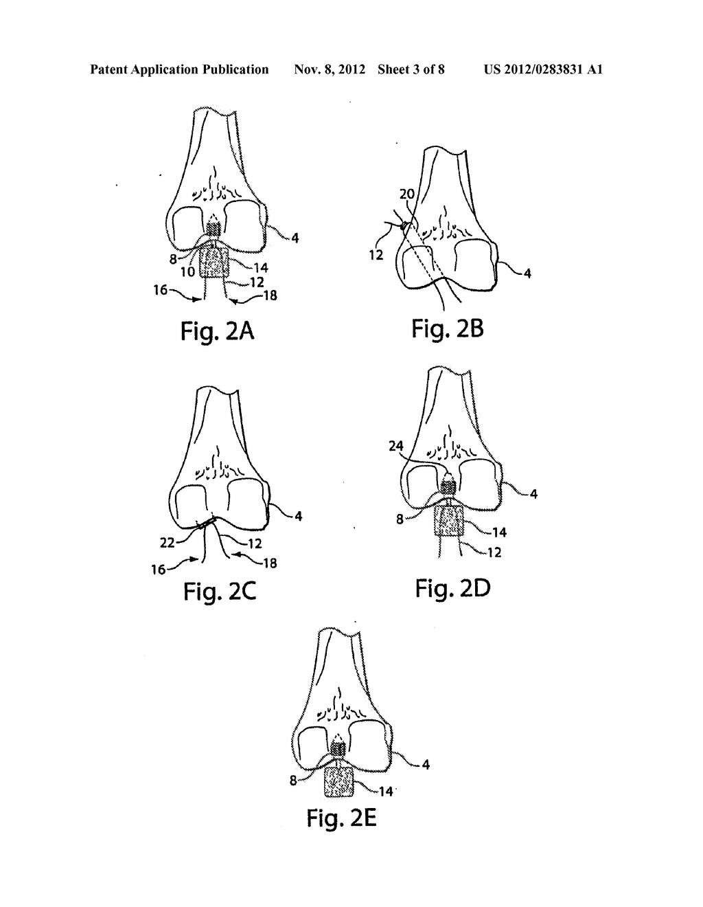 METHODS AND PROCEDURES FOR LIGAMENT REPAIR - diagram, schematic, and image 04