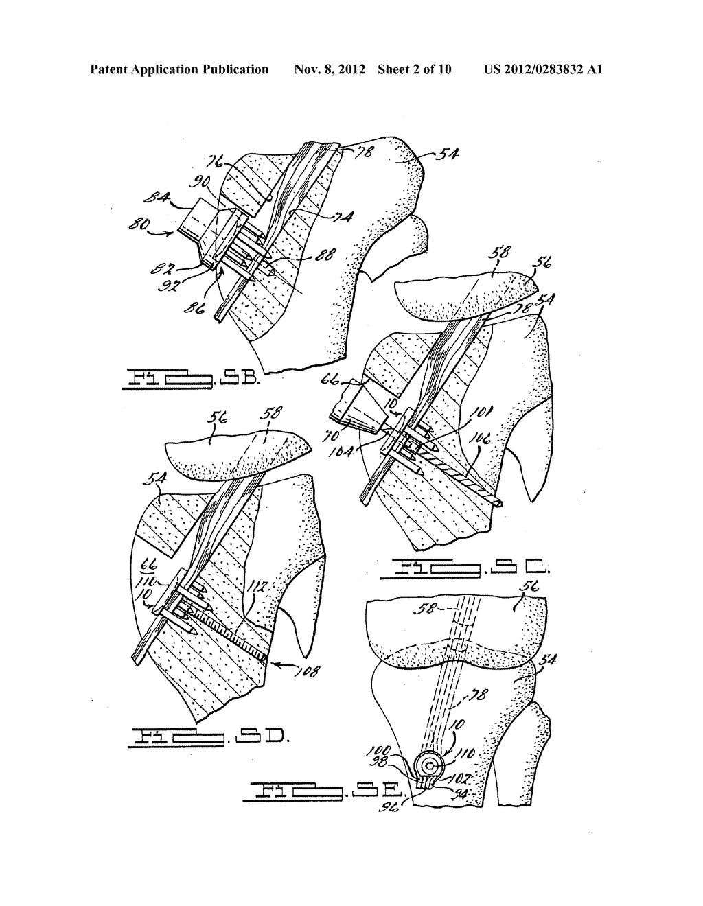 Apparatus And Method For Tibial Fixation Of Soft Tissue - diagram, schematic, and image 03