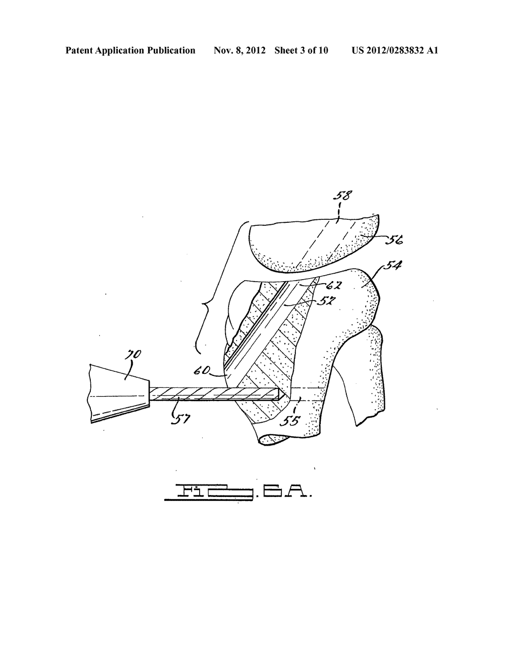 Apparatus And Method For Tibial Fixation Of Soft Tissue - diagram, schematic, and image 04