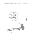 Dynamic Surgical Implant diagram and image