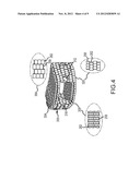 Dynamic Surgical Implant diagram and image