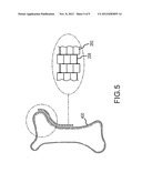 Dynamic Surgical Implant diagram and image