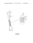 Dynamic Surgical Implant diagram and image