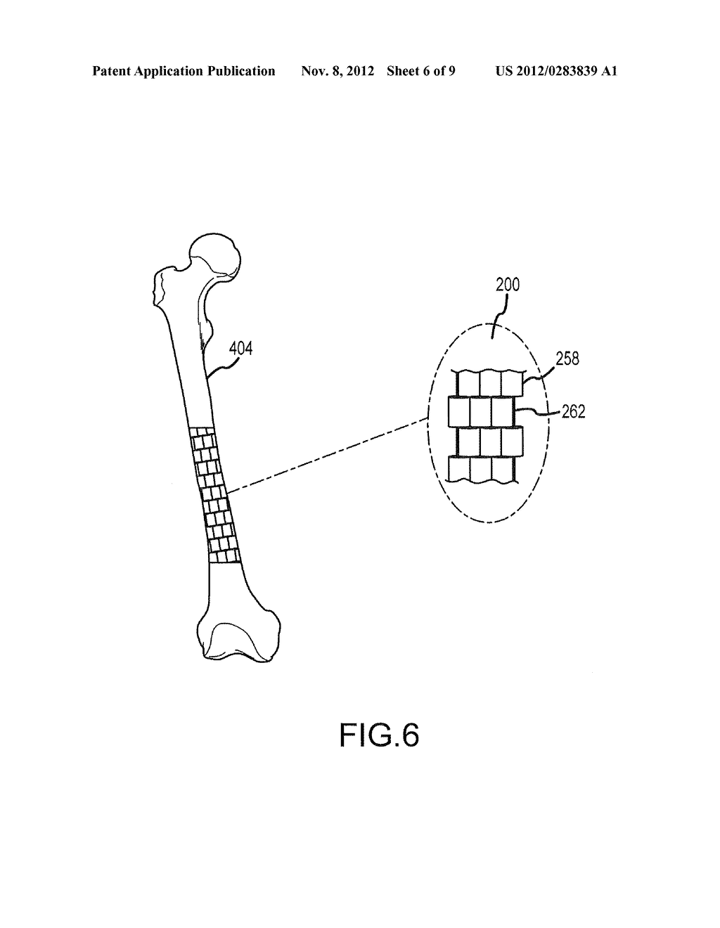 Dynamic Surgical Implant - diagram, schematic, and image 07