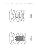 Dynamic Surgical Implant diagram and image