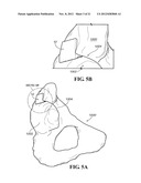 METHODS AND APPARATUS FOR FAI SURGERIES diagram and image