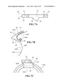 METHODS AND APPARATUS FOR FAI SURGERIES diagram and image