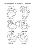 METHODS AND APPARATUS FOR FAI SURGERIES diagram and image